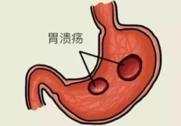 上消化道出血最常见的原因,揭秘最常见的病因与防治策略